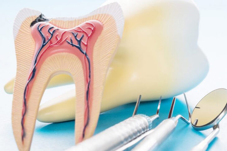 Root Canal Treatment In Mahim